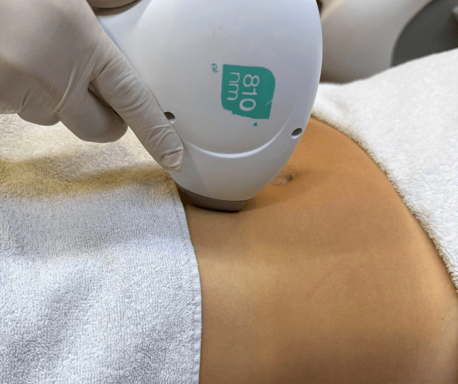 epilazione-laser-cinquefrondi-addome