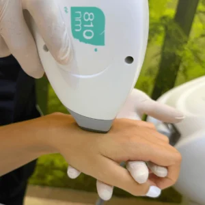 epilazione-laser-mani-cinquefrondi