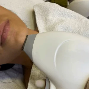 epilazione-laser-mento-cinquefrondi