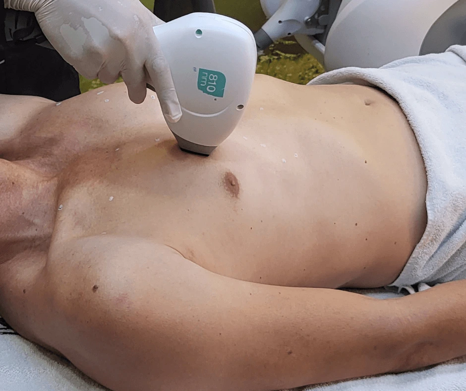 epilazione-laser-petto-uomo-cinquefrondi