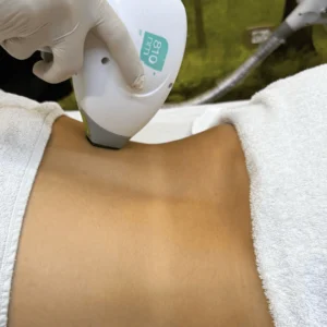 epilazione-laser-schiena-cinquefrondi