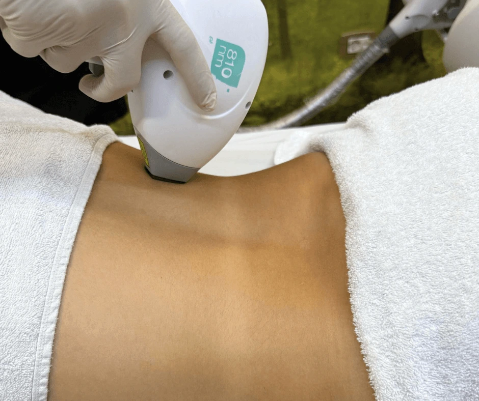 epilazione-laser-schiena-cinquefrondi