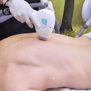 epilazione-laser-schiena-uomo-cinquefrondi