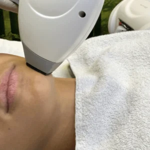 epilazione-laser-viso-cinquefrondi