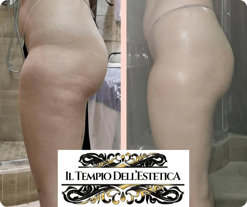 risultati-prima-e-dopo-dimagrire-senza-dieta-a-cinquefrondi-con-il-metodo-te