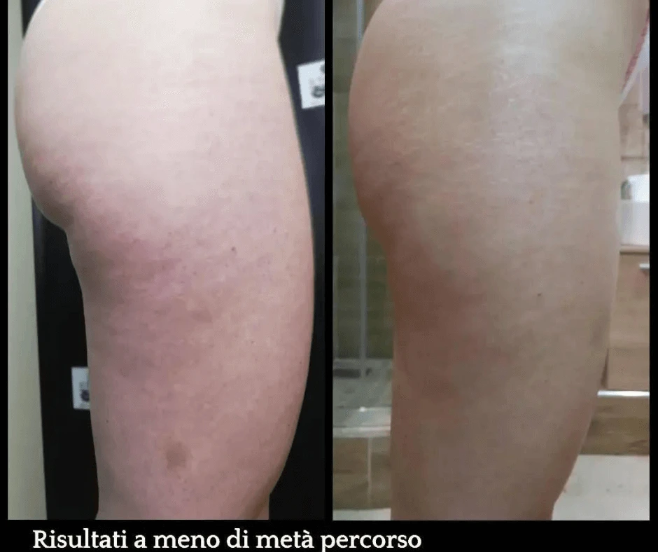 trattamento-anticellulite-e-rimodellante-gambe-glutei-a-cinquefrondi-al-tempio-dell-estetica