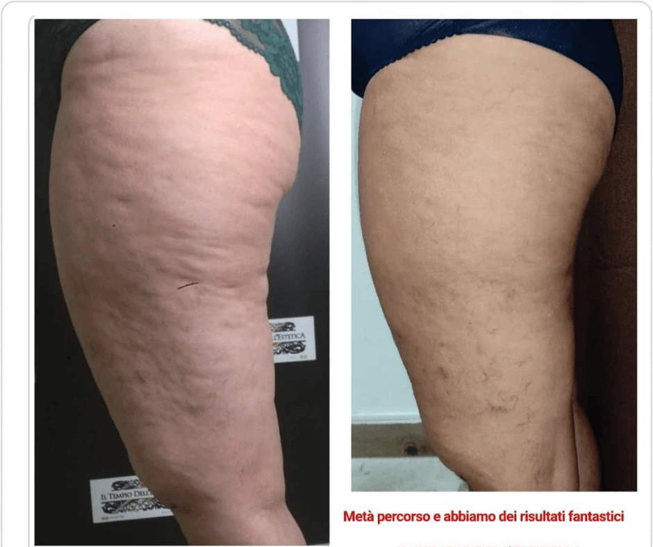 trattamento-dimagrante-e-rimodellante-gambe-glutei-a-cinquefrondi-al-tempio-dell-estetica