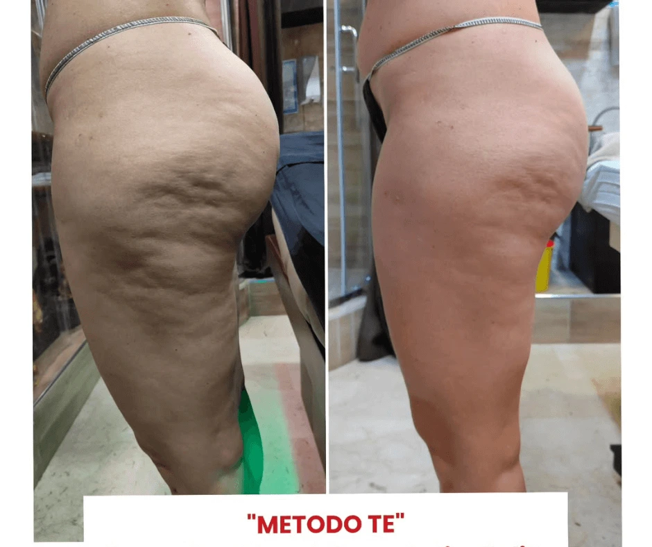trattamento-per-rimodellamento-corpo-a-cinquefrondi-centro-estetico-il-tempio-dell-estetica