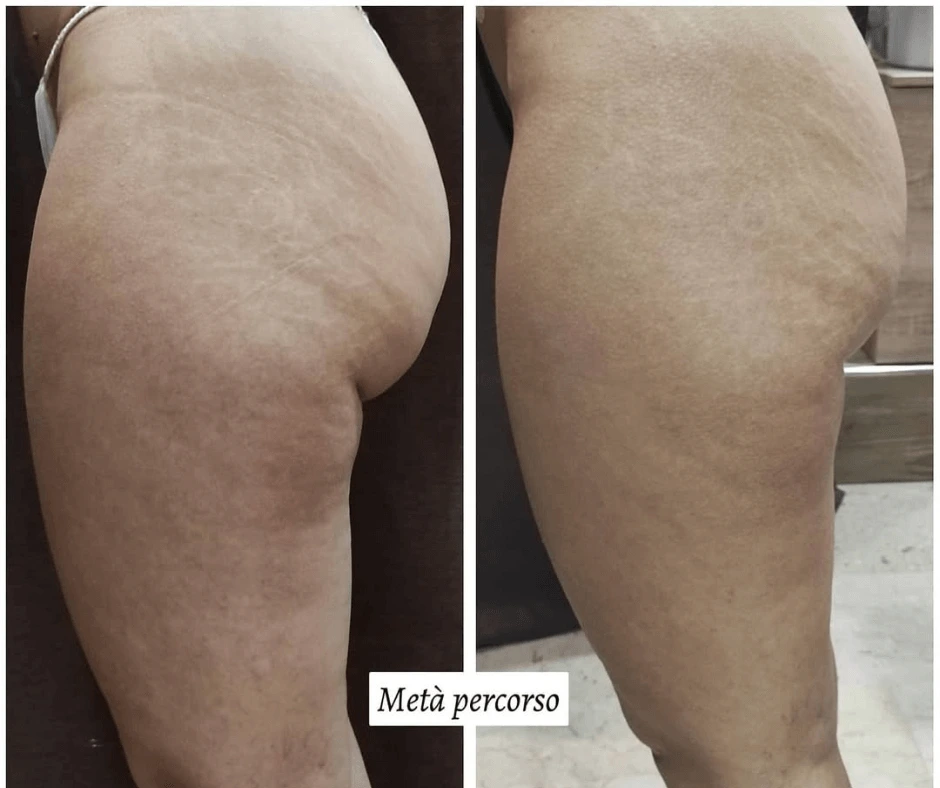 trattamento-rimodellante-gambe-glutei-a-cinquefrondi-al-tempio-dell-estetica