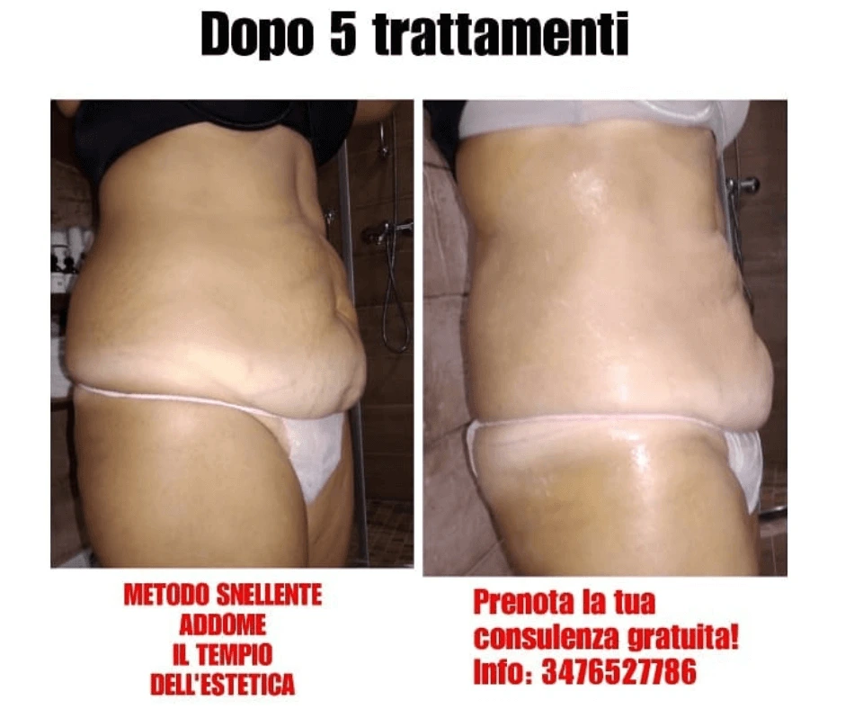 trattamento-snellente-a-cinquefrondi-al-tempio-dell-estetica