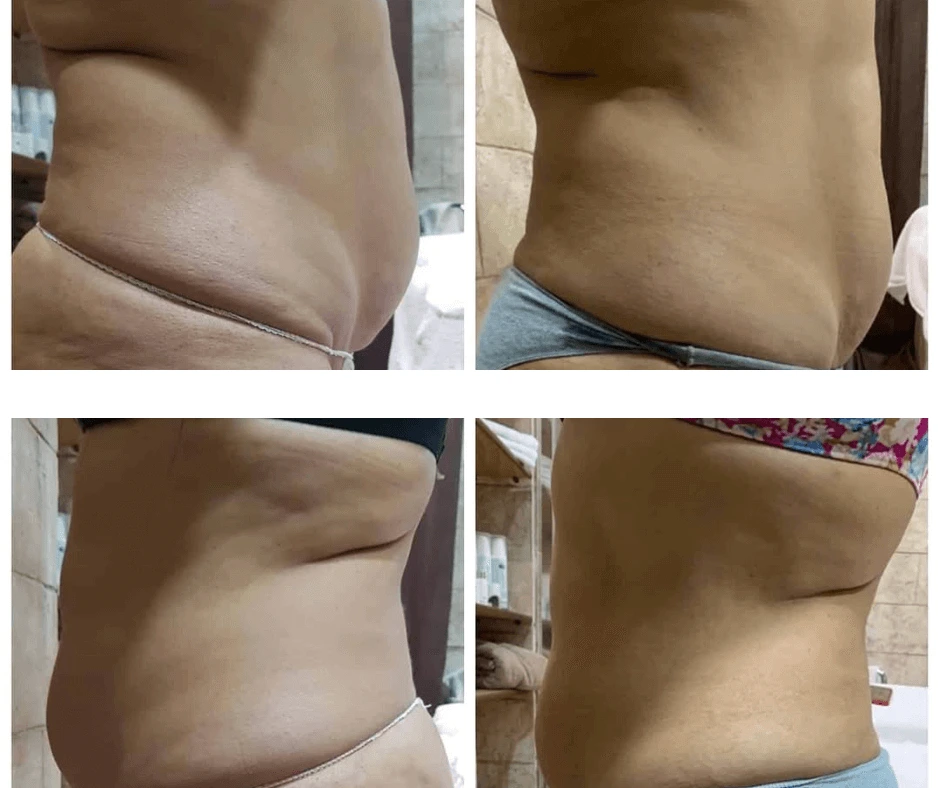 trattamento-snellente-addome-a-cinquefrondi