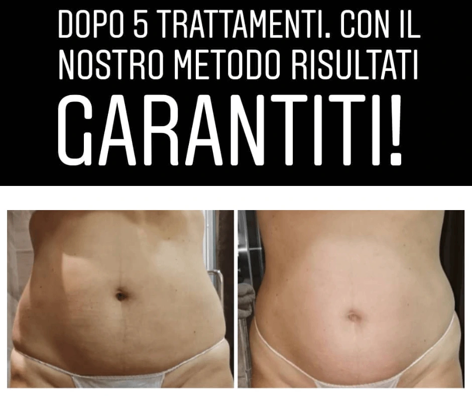 trattamento-snellente-addome-dopo-5-trattamenti-al-tempio-dell-estetica-cinquefrondi