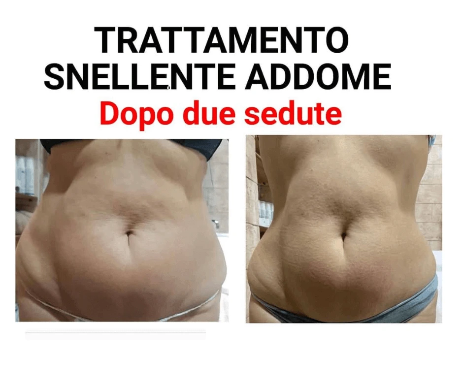 trattamento-snellente-addome-senza-dieta-estrema-con-il-metodo-te-prima-e-dopo-dopo-due-sedute