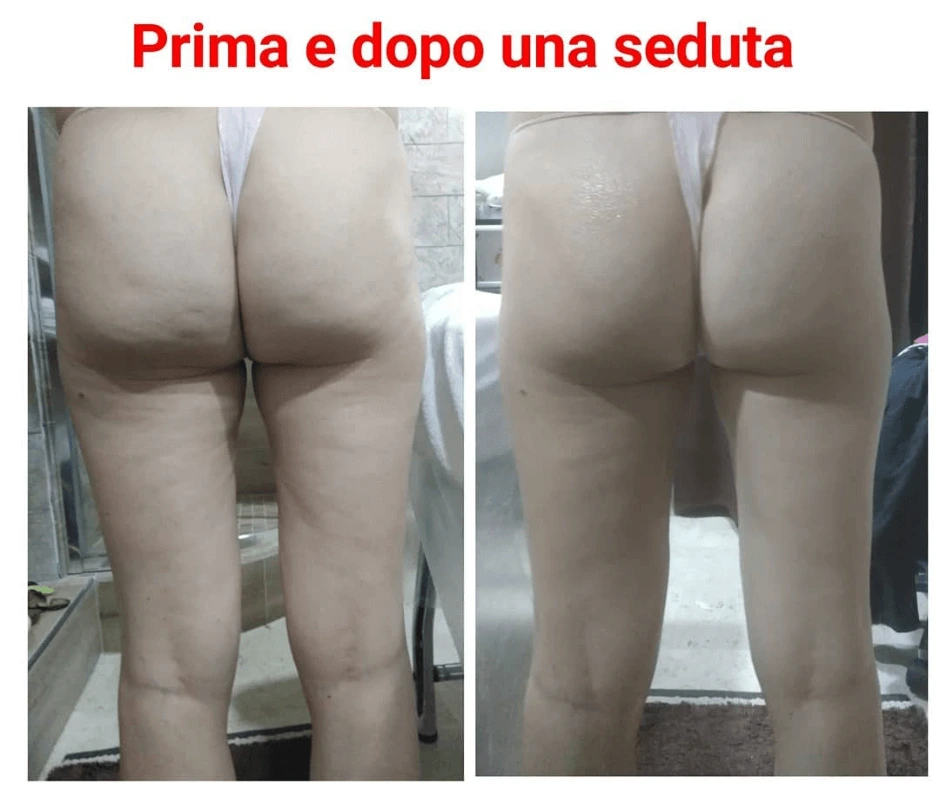 trattamento-snellente-e-rimodellante-gambe-glutei-a-cinquefrondi-al-tempio-dell-estetica