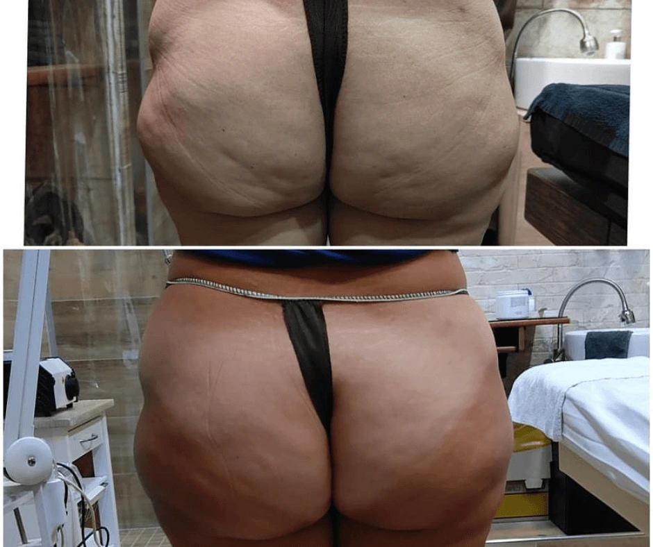 trattamento-snellente-e-rimodellante-glutei-a-cinquefrondi-al-tempio-dell-estetica