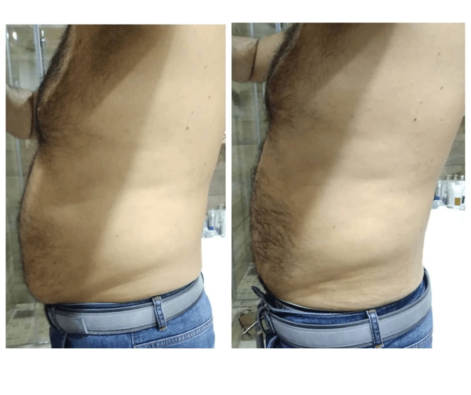 trattamento-snellente-pancia-uomo-a-cinquefrondi