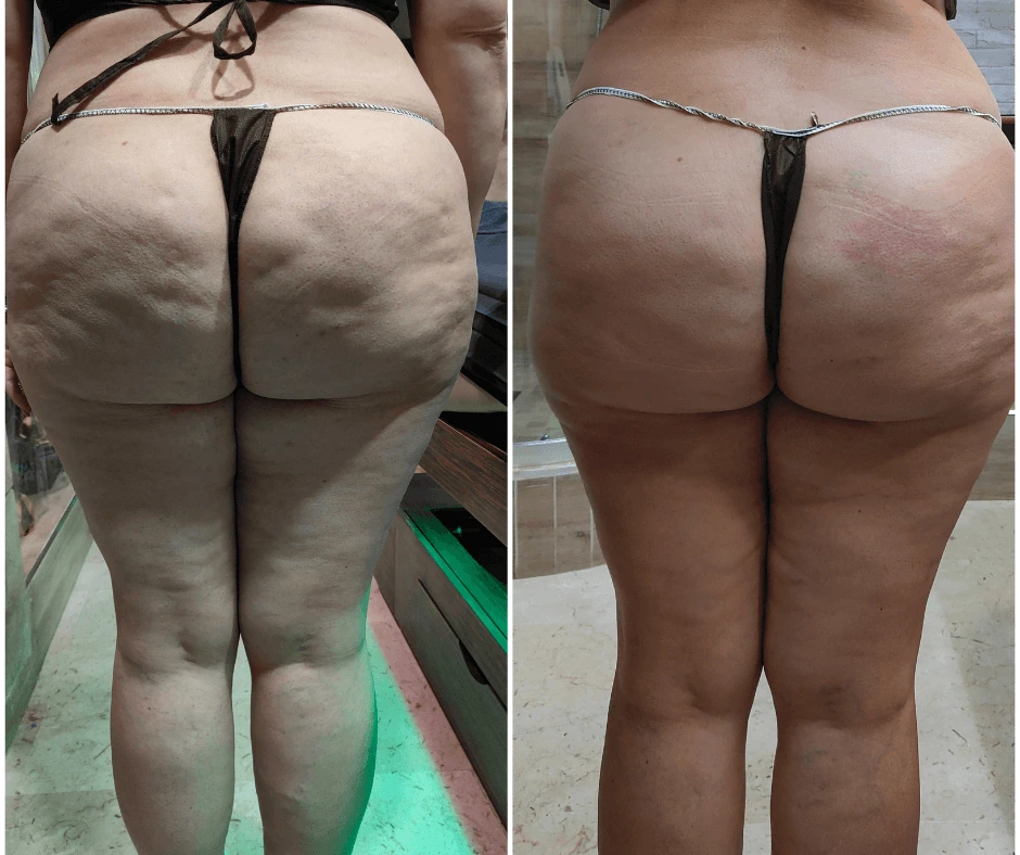 dopo-poche-sedute-prima-e-dopo-trattamento-dimagrante-e-rimodellante-gambe-glutei-ritenzione-idrica-centro-estetico-a-cinquefrondi-al-tempio-dell-estetica