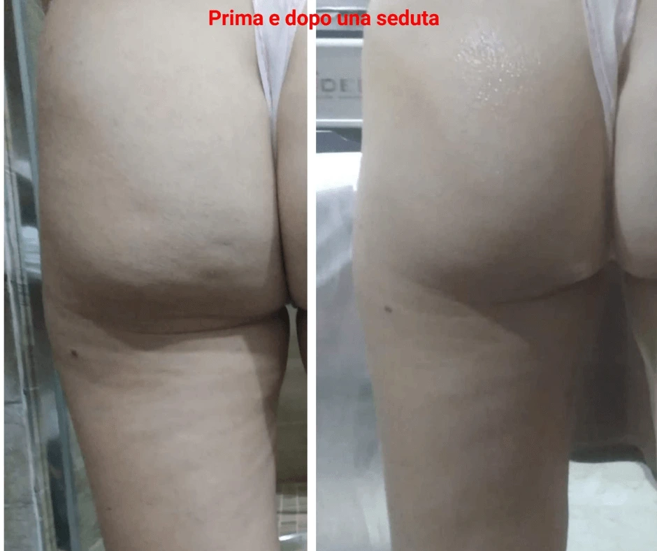 dopo-una-sola-seduta-prima-e-dopo-trattamento-dimagrante-e-rimodellante-gambe-glutei-centro-estetico-a-cinquefrondi-al-tempio-dell-estetica