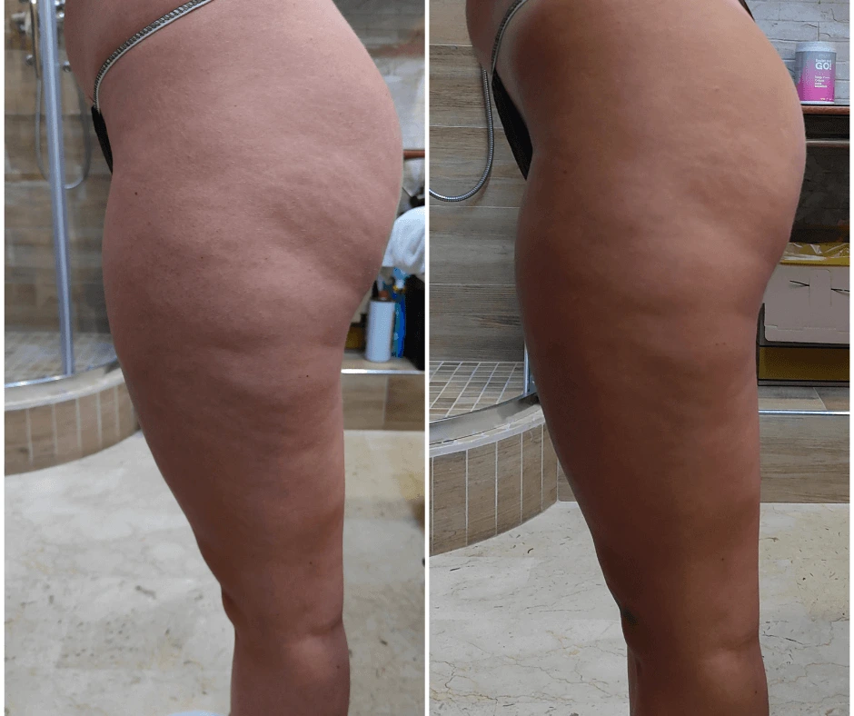 elimina-cellulite-con-trattamento-dimagrante-e-rimodellante-gambe-glutei-a-cinquefrondi-al-tempio-dell-estetica