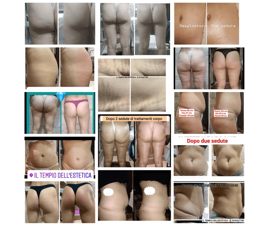 foto-di-prima-e-dopo-pancia-piatta-glutei-piu-tonici-senza-cellulite-riduzione-delle-smagliature-dimagrire-senza-dieta-centro-estetico-cinquefrondi-il-tempio-dell-estetica