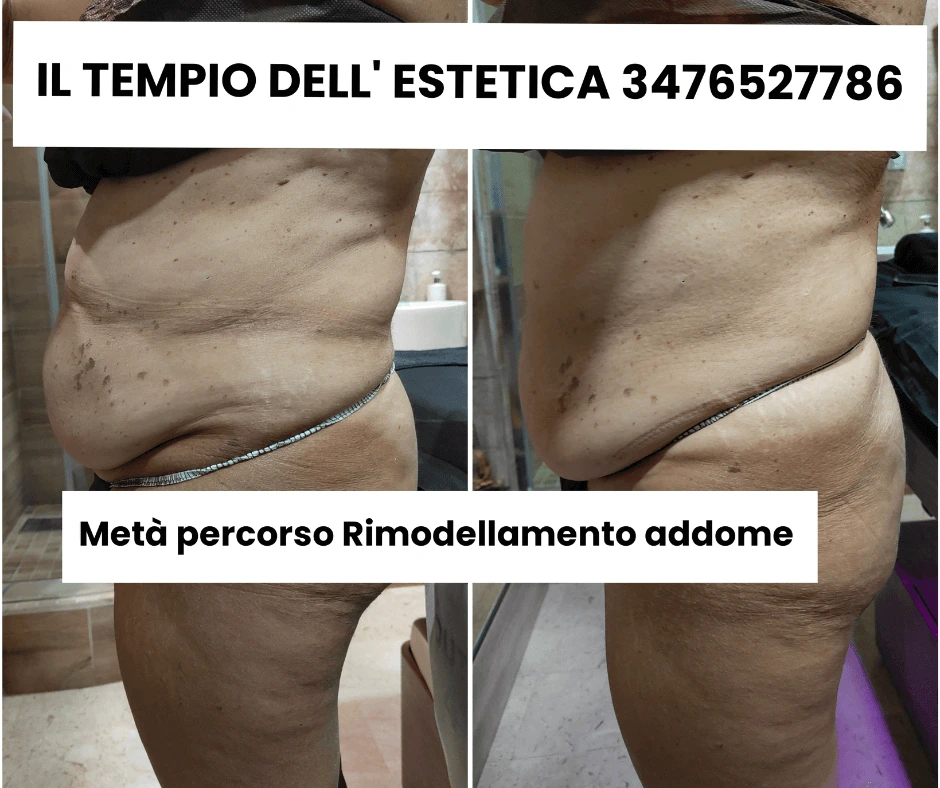 metà-percorso-prima-e-dopo-rimodellamento-addome-senza-dieta-estrema-centro-estetico-cinquefrondi