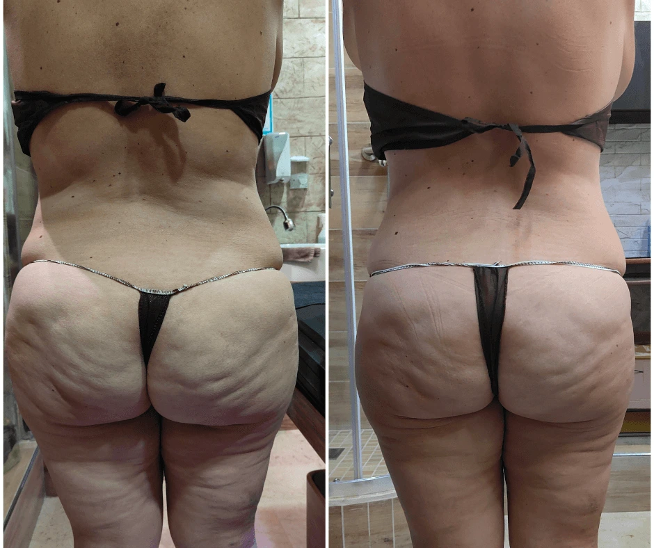 prima-dopo-trattamento-dimagrante-e-rimodellante-gambe-glutei-a-cinquefrondi-al-tempio-dell-estetica