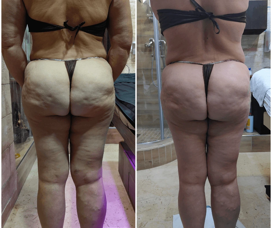 prima-e-dopo-elimina-la-cellulite-con-trattamento-dimagrante-e-rimodellante-gambe-glutei-a-cinquefrondi-al-tempio-dell-estetica