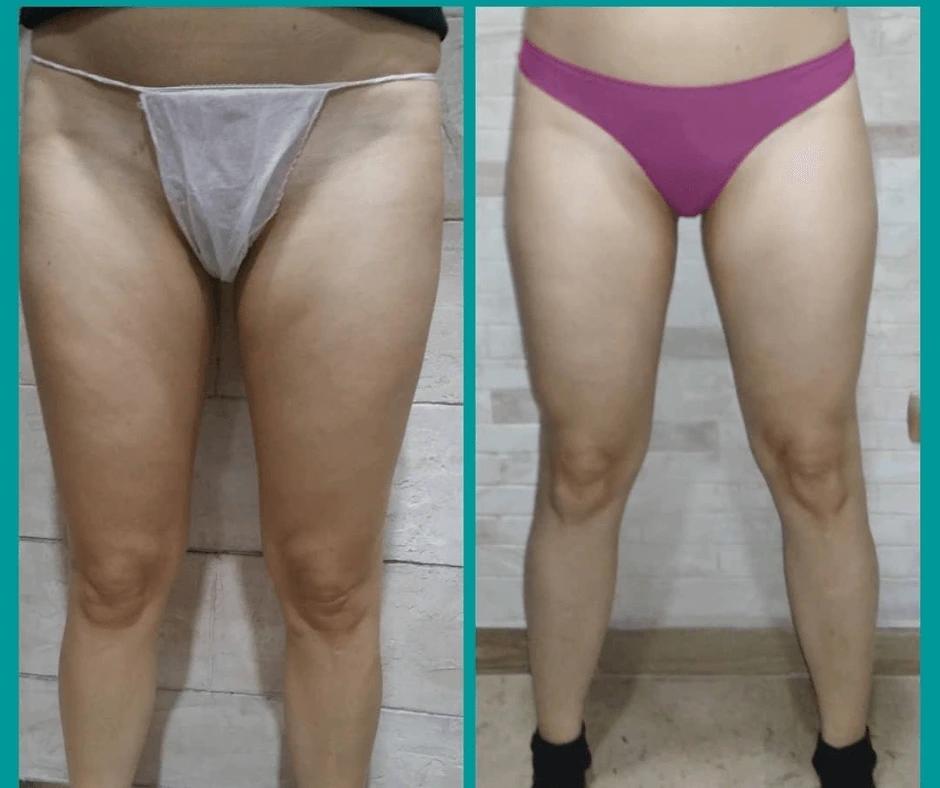 prima-e-dopo-riduzione-della-cellulite-con-trattamento-dimagrante-e-rimodellante-gambe-centro-estetico-a-cinquefrondi-al-tempio-dell-estetica