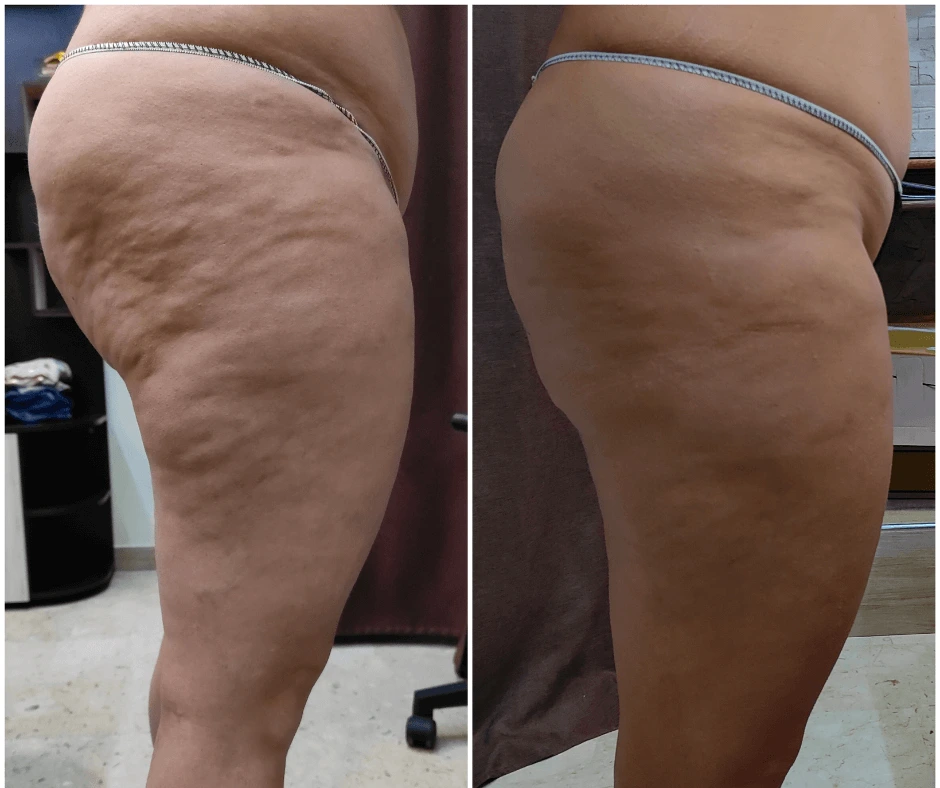 prima-e-dopo-riduzione-della-cellulite-trattamento-dimagrante-e-rimodellante-gambe-glutei-centro-estetico-a-cinquefrondi-al-tempio-dell-estetica