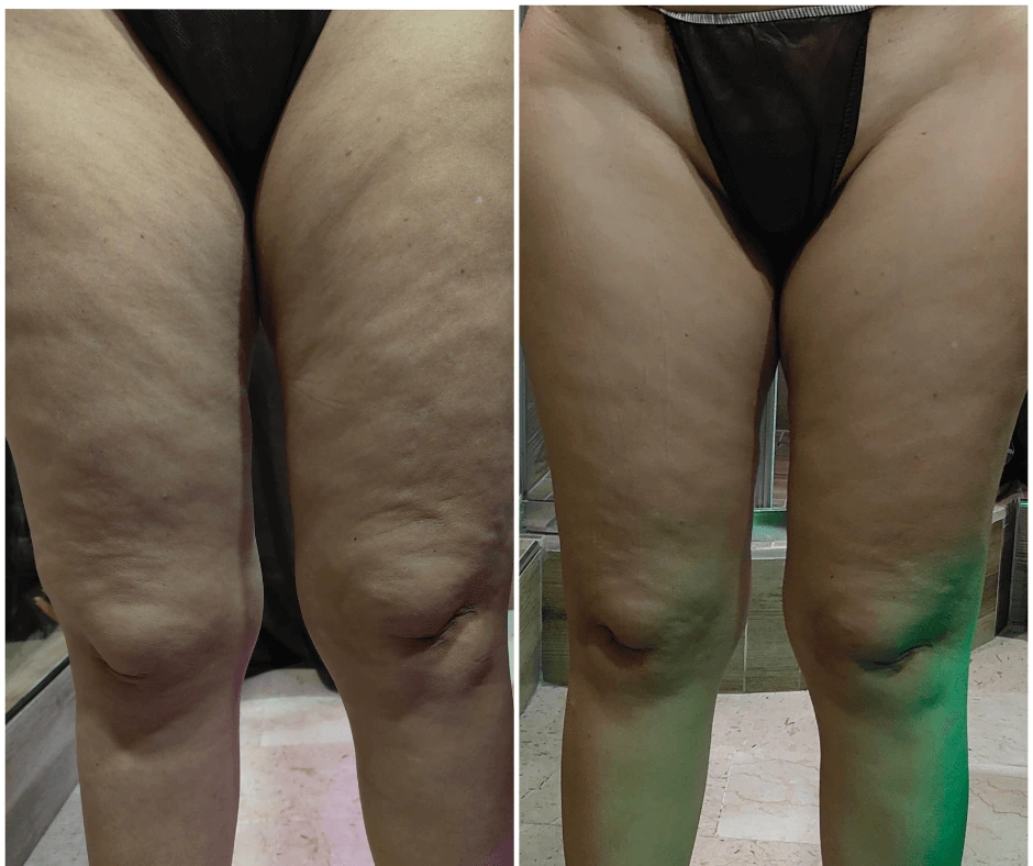 prima-e-dopo-rimodellamento-gambe-senza-dieta-estrema-eliminare-la-cellulite-centro-estetico-cinquefrondi