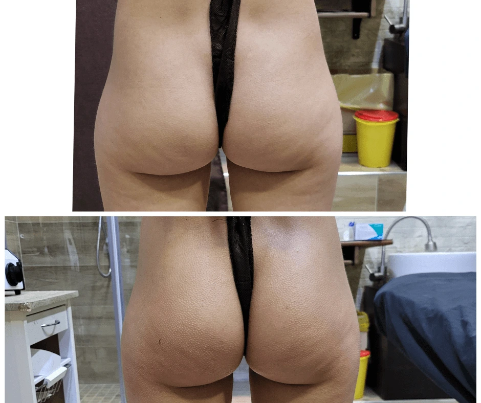 prima-e-dopo-rimodellamento-glutei-senza-dieta-drastica-senza-cellulite-centro-estetico-cinquefrondi
