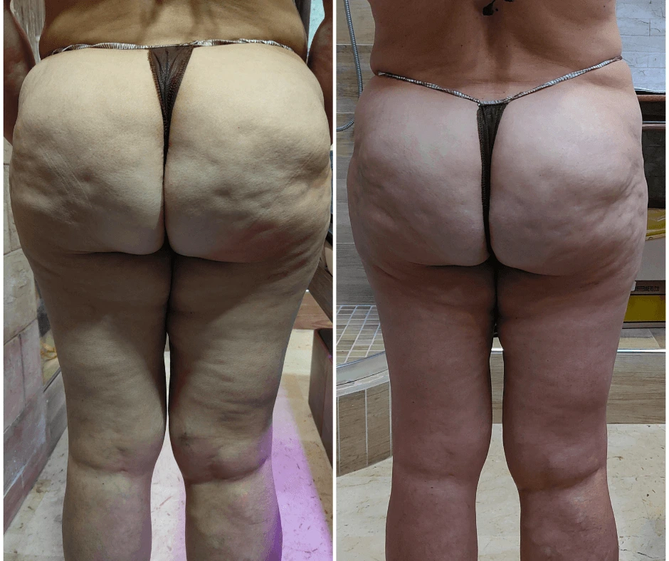 prima-e-dopo-rimodellamento-glutei-senza-dieta-estrema-centro-estetico-cinquefrondi-eliminare-la-cellulite