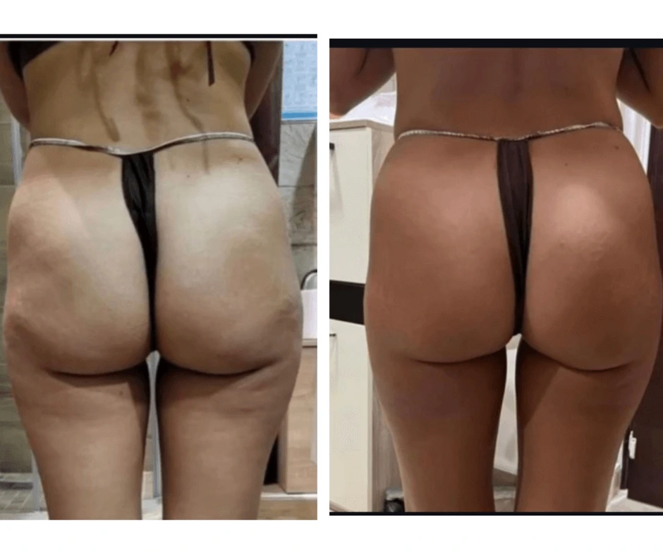 prima-e-dopo-rimodellamento-glutei-senza-dieta-estrema-centro-estetico-cinquefrondi