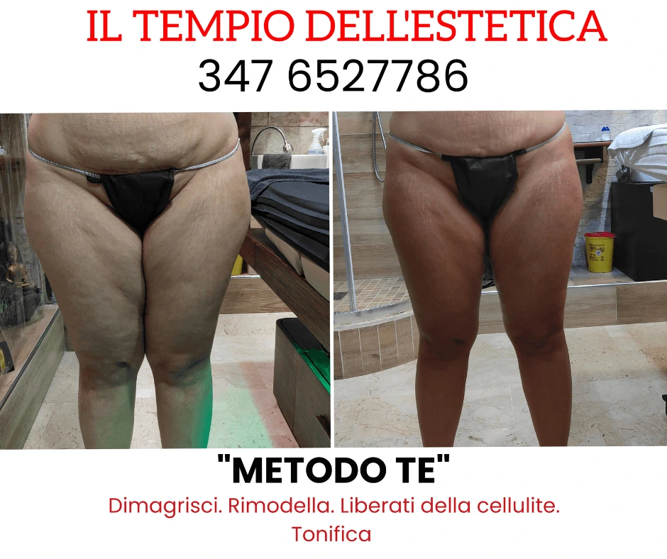 prima-e-dopo-trattamento-dimagrante-e-rimodellante-gambe-centro-estetico-a-cinquefrondi-al-tempio-dell-estetica-riduzione-cellulite