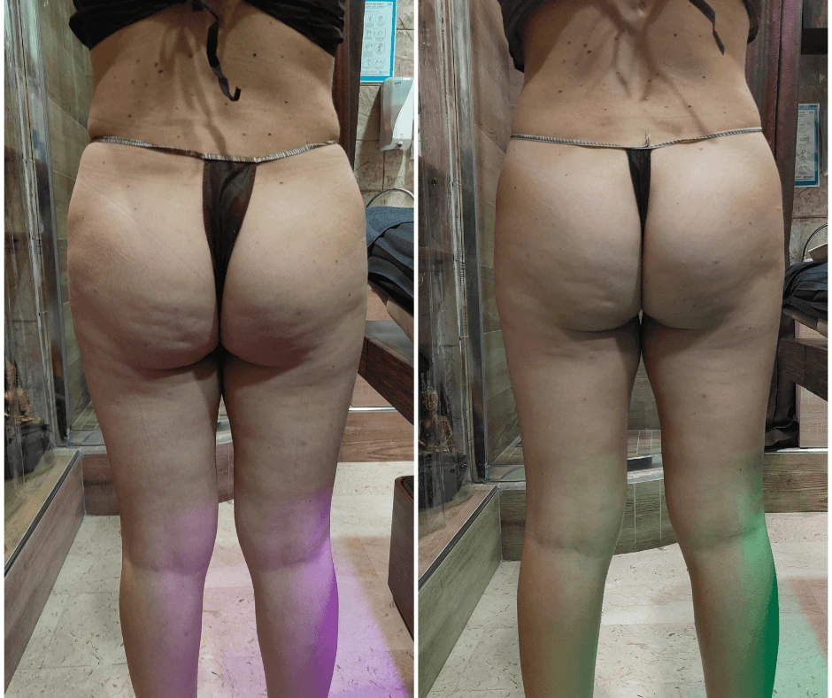 prima-e-dopo-trattamento-dimagrante-e-rimodellante-gambe-glutei-a-cinquefrondi-al-tempio-dell-estetica