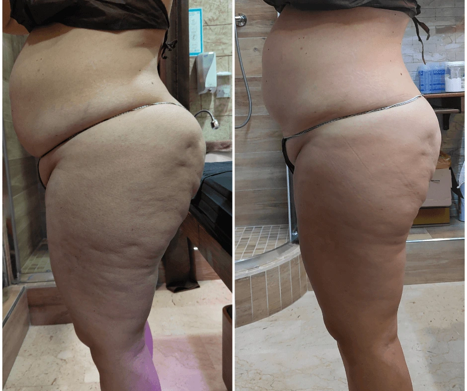 prima-e-dopo-trattamento-dimagrante-e-rimodellante-gambe-glutei-addome-estetica-a-cinquefrondi-al-tempio-dell-estetica