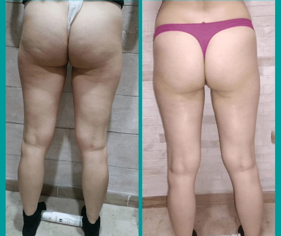 prima-e-dopo-trattamento-dimagrante-e-rimodellante-gambe-glutei-centro-estetico-a-cinquefrondi-al-tempio-dell-estetica-mai-più-cellulite