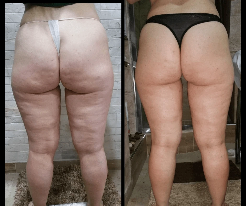 prima-e-dopo-trattamento-dimagrante-e-rimodellante-gambe-glutei-centro-estetico-a-cinquefrondi-al-tempio-dell-estetica-riduzione-visibile-di-cellulite