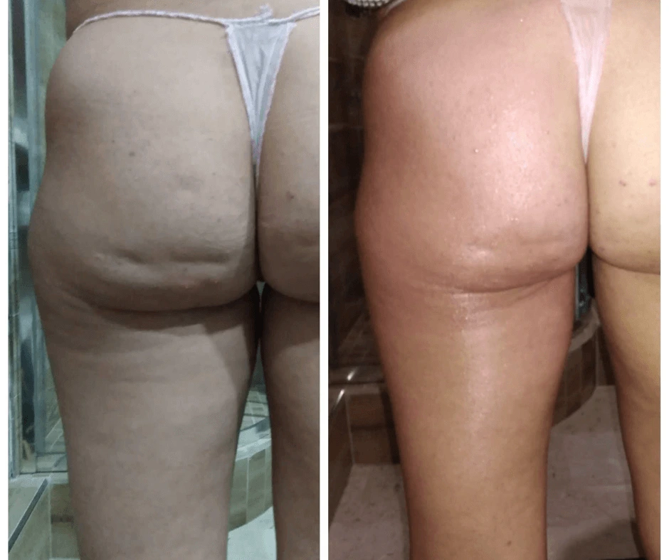 prima-e-dopo-trattamento-dimagrante-e-rimodellante-gambe-glutei-centro-estetico-a-cinquefrondi-al-tempio-dell-estetica