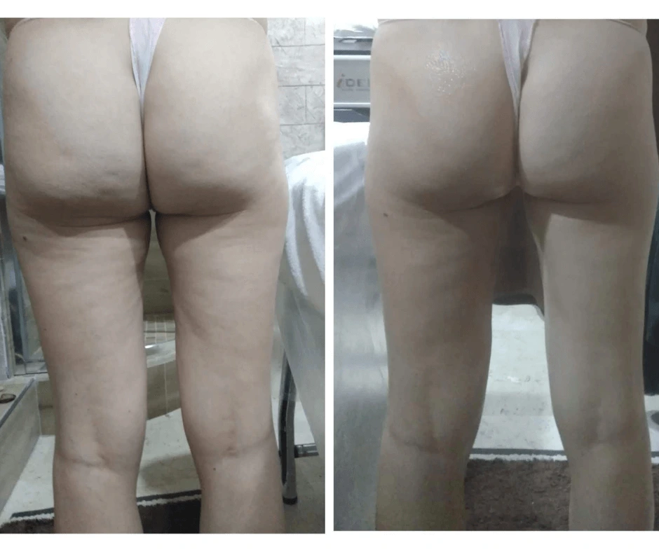 prima-e-dopo-trattamento-dimagrante-e-rimodellante-gambe-glutei-elimina-cellulite-ritenzione-idrica-centro-estetico-a-cinquefrondi-al-tempio-dell-estetica