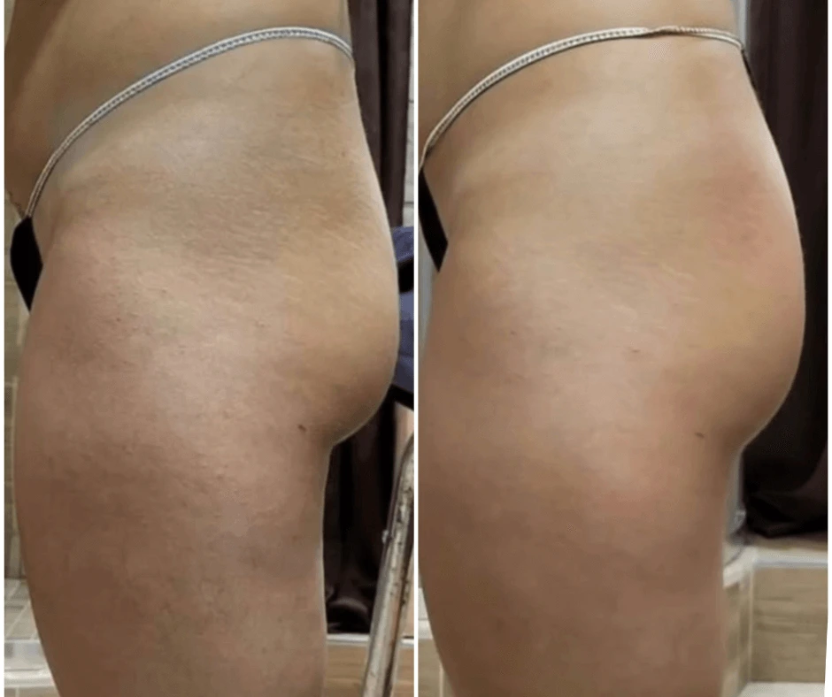 prima-e-dopo-trattamento-dimagrante-e-rimodellante-gambe-glutei-piu-tonici-centro-estetico-a-cinquefrondi-al-tempio-dell-estetica