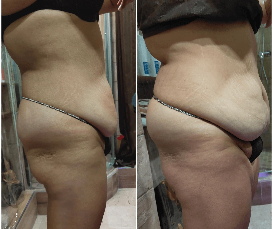 primo-profilo-prima-e-dopo-rimodellamento-addome-senza-dieta-estrema-eliminare-la-cellulite-centro-estetico-cinquefrondi