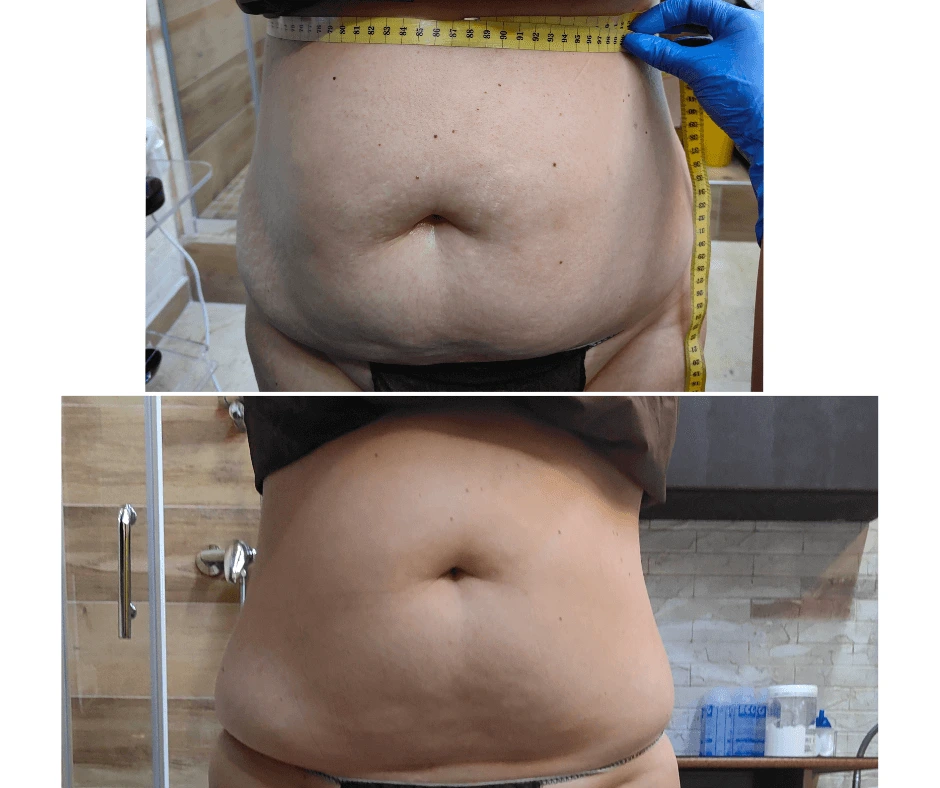 riduzione-centimetri-addome-donna-trattamento-pancia-piatta-addome-tonico-riduzione-cellulite-centro-estetico-cinquefrondi