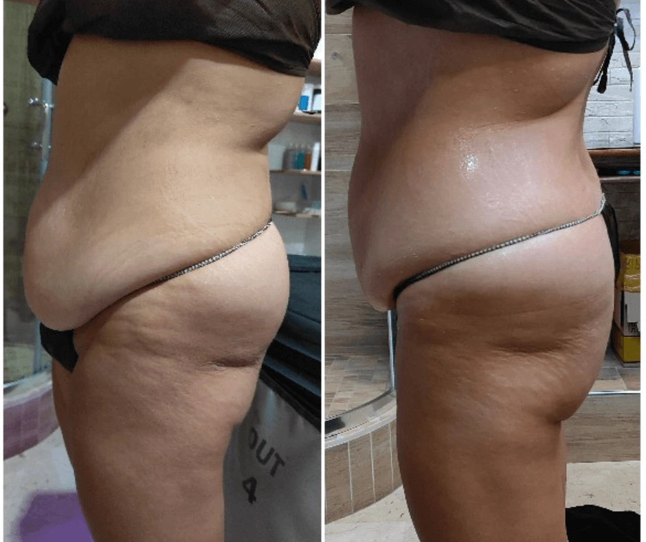 secondo-profilo-prima-e-dopo-rimodellamento-addome-senza-dieta-estrema-eliminare-la-cellulite-centro-estetico-cinquefrondi