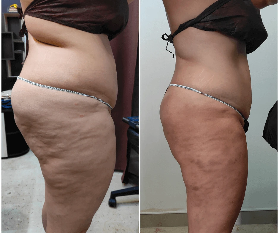 trattamento-dimagrante-e-rimodellante-gambe-glutei-addome-centro-estetico-a-cinquefrondi-al-tempio-dell-estetica