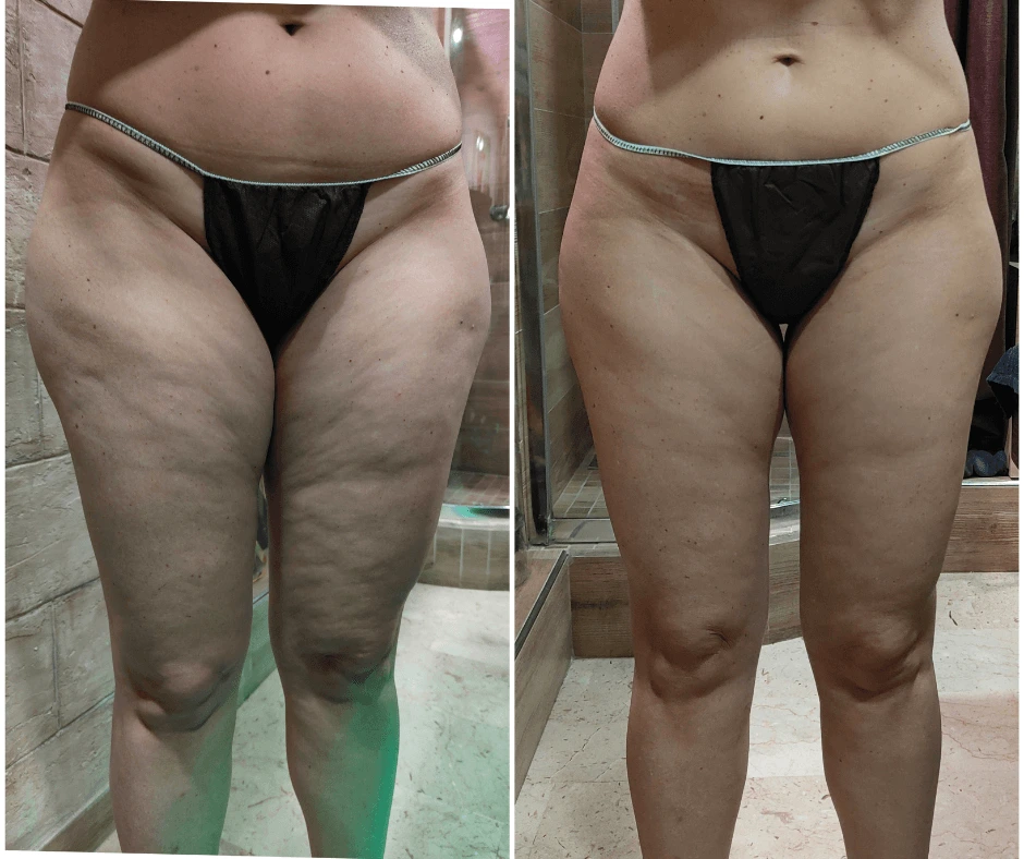 trattamento-dimagrante-e-rimodellante-gambe-glutei-prima-e-dopo-a-cinquefrondi-al-tempio-dell-estetica